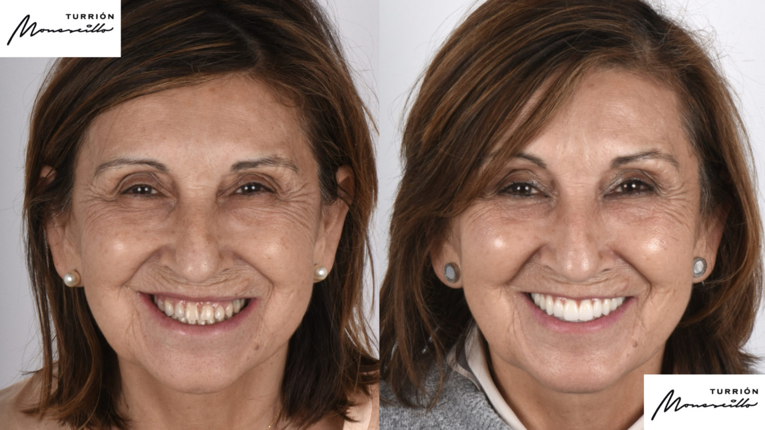 Implantes Dentales Madrid Clinica Dental Madrid - Clinica Dental Madrid ...