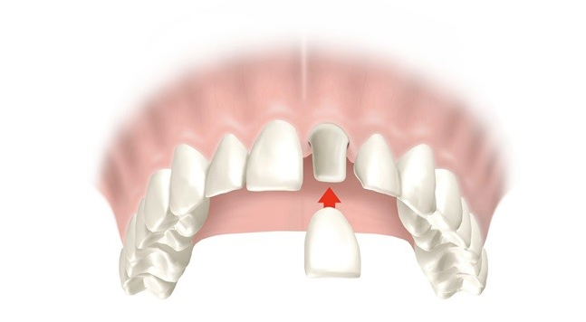 corona dental clinica dental madrid turrion monescillo